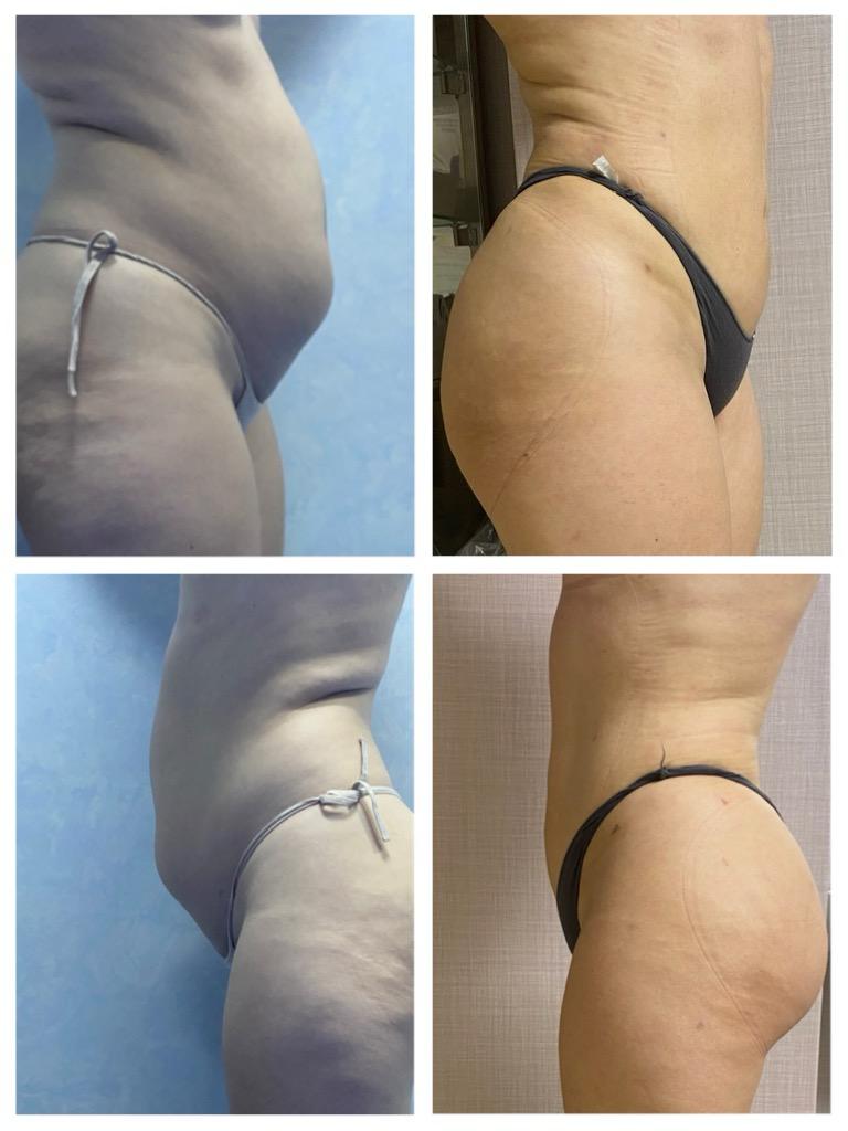 Lipoaspiratie indepartare grasime
