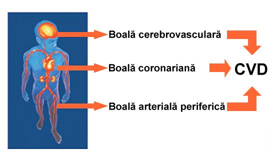 ateroscleroza forme clinice