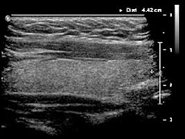 Ecografie glanda tiroida plan longitudinal.jpg