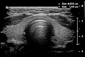 Ecografie glanda tiroida plan transvers