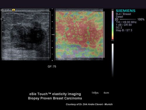 Elastography image Acuson S2000