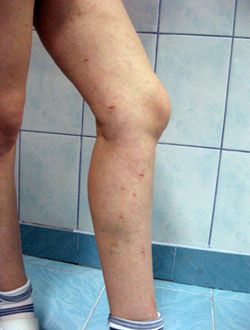 phlebology varicose veins treatment