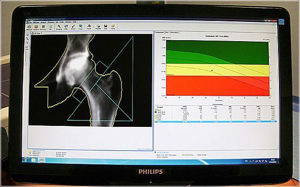 Osteodensitometry test electronic result