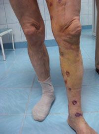 large varicose veins treatment - after